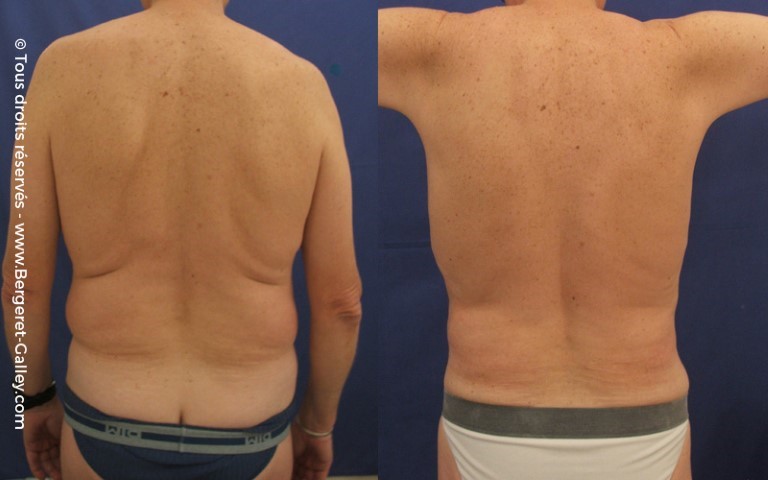 Liposuccion, cas 2, photographie avant et après