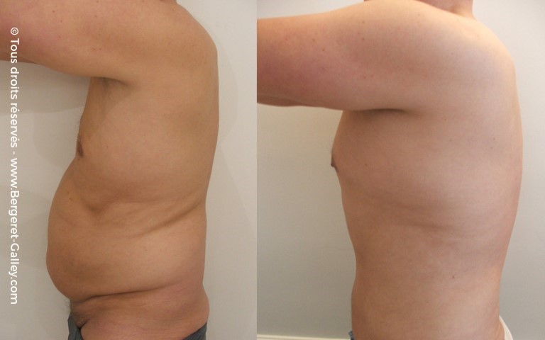 Liposuccion, cas 3, photographie avant et après