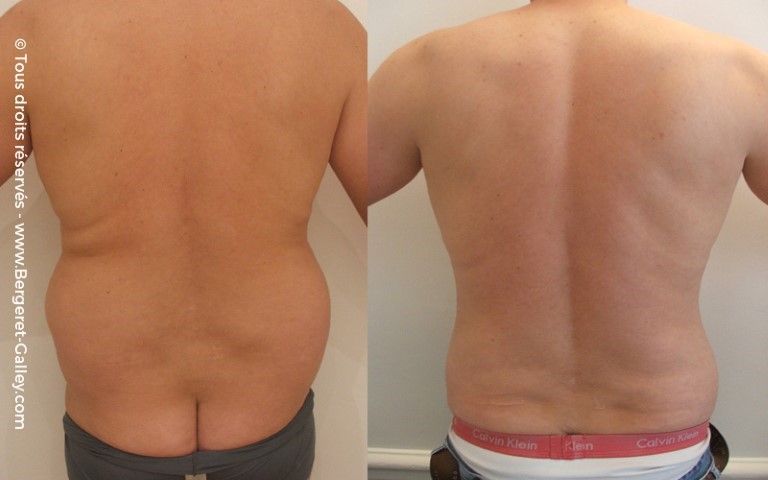 Liposuccion, cas 4, photographie avant et après