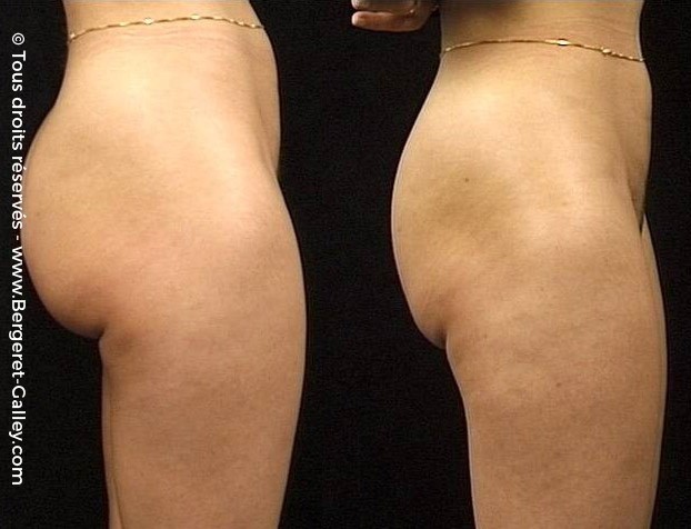 Liposuccion, cas 5, photographie avant et après