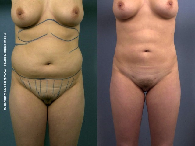 Liposuccion, cas 6, photographie avant et après