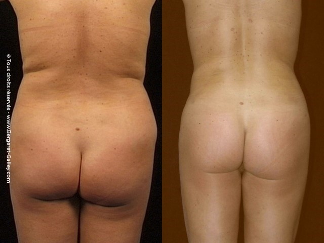 Liposuccion, cas 7, photographie avant et après