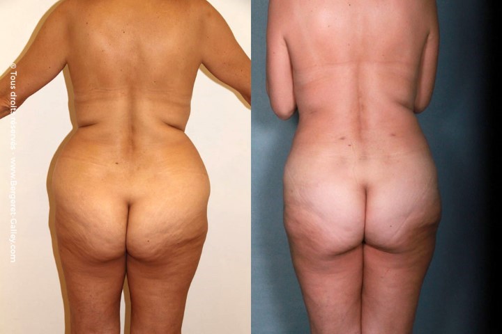 Liposuccion, cas 10, photographie avant et après