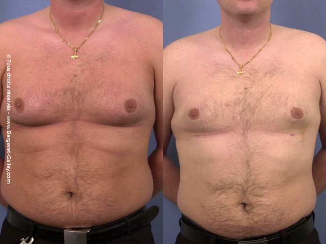 Liposuccion, cas 11, photographie avant et après