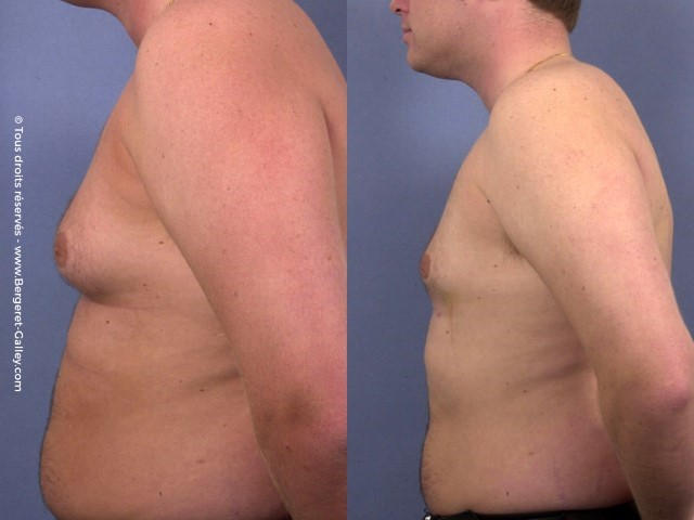 Liposuccion, cas 12, photographie avant et après