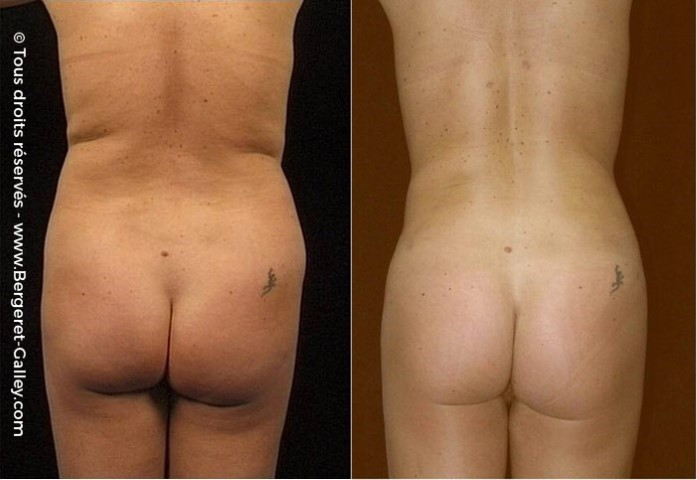 Liposuccion, cas 13, photographie avant et après