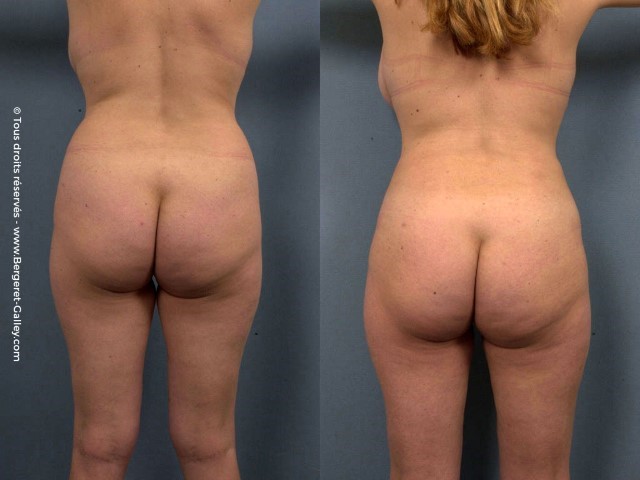 Liposuccion, cas 14, photographie avant et après