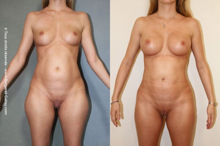 Liposuccion, cas 15, photographie avant et après