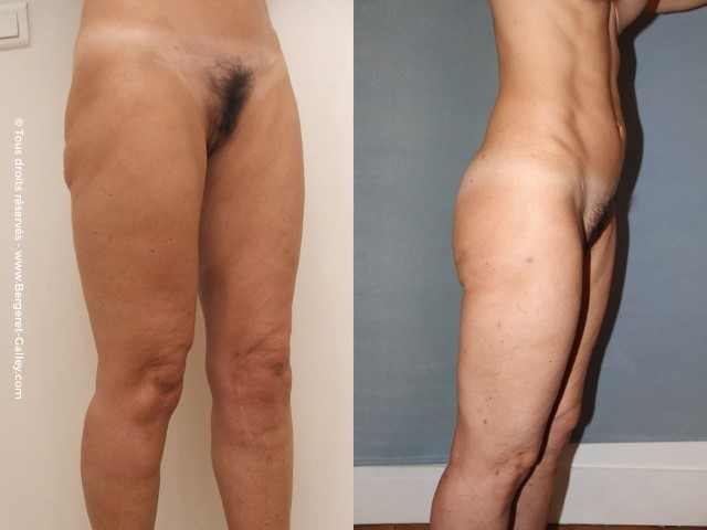Liposuccion, cas 17, photographie avant et après