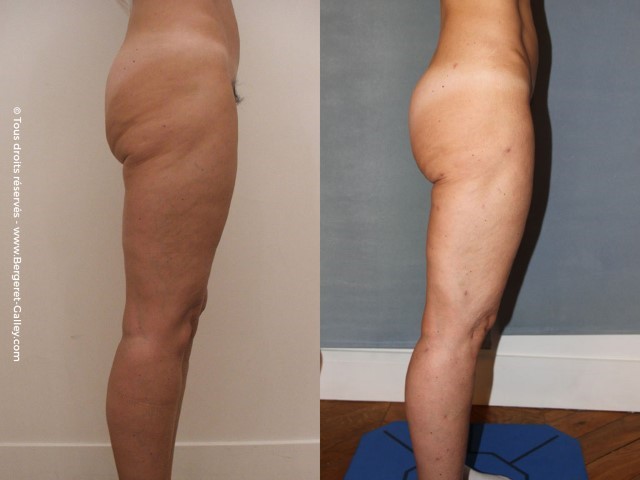 Liposuccion, cas 18, photographie avant et après