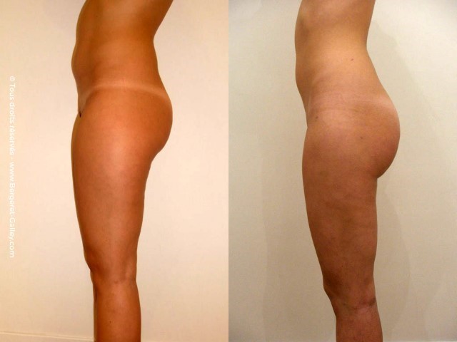 Liposuccion, cas 20, photographie avant et après