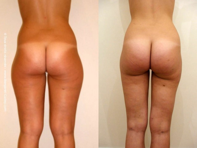 Liposuccion, cas 21, photographie avant et après