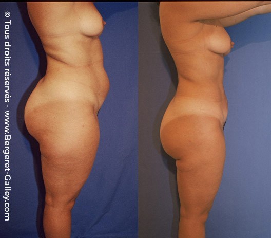 Liposuccion, cas 22, photographie avant et après