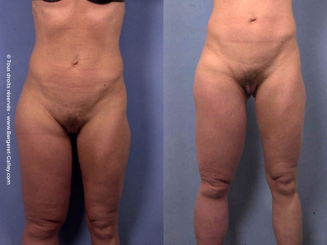 Liposuccion, cas 23, photographie avant et après