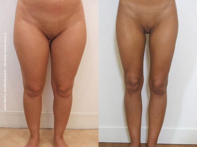 Liposuccion, cas 24, photographie avant et après