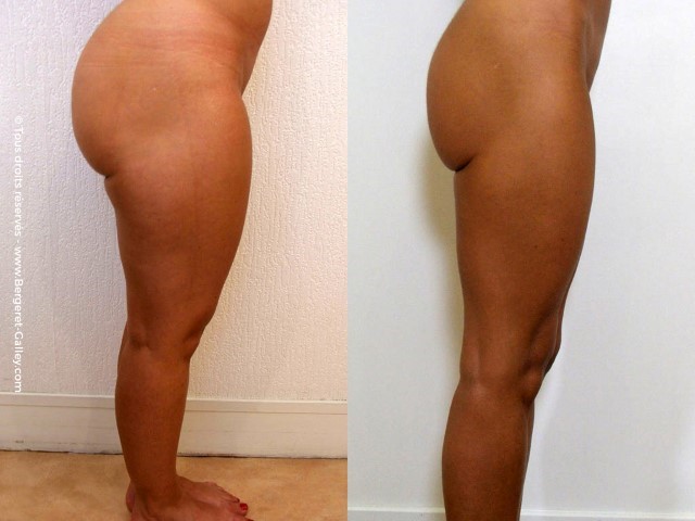 Liposuccion, cas 25, photographie avant et après