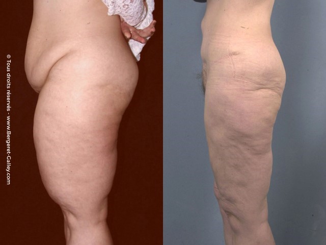 Liposuccion, cas 26, photographie avant et après