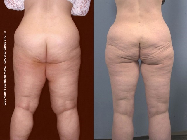 Liposuccion, cas 27, photographie avant et après