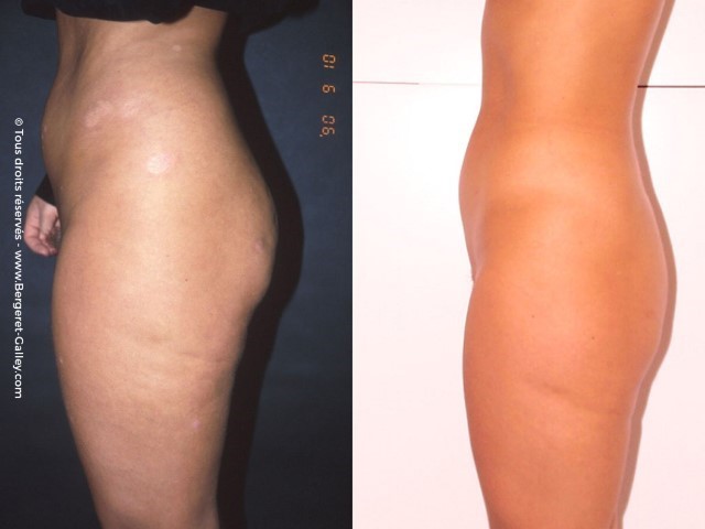 Liposuccion, cas 28, photographie avant et après