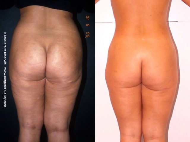 Liposuccion, cas 29, photographie avant et après