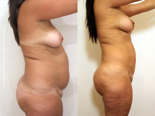 Liposuccion, cas 30, photographie avant et après