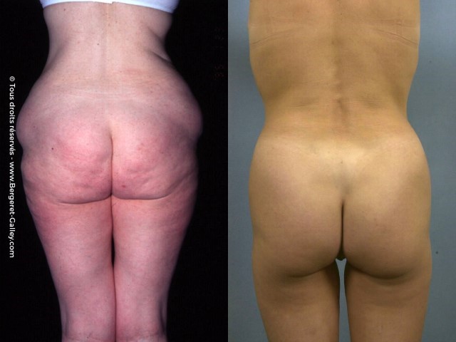 Liposuccion, cas 32, photographie avant et après