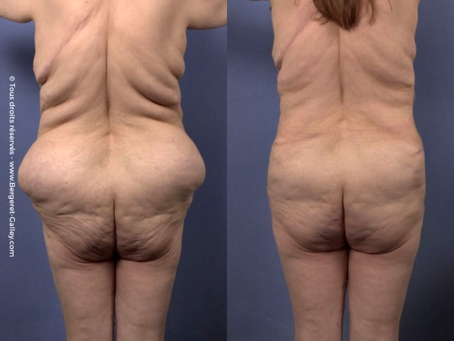 Liposuccion, cas 33, photographie avant et après