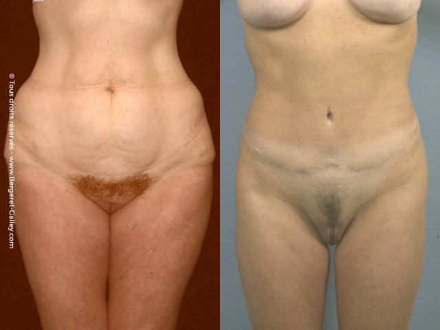 Liposuccion, cas 34, photographie avant et après
