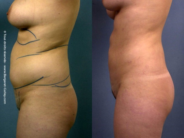Liposuccion, cas 35, photographie avant et après