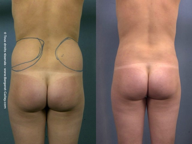 Liposuccion, cas 36, photographie avant et après