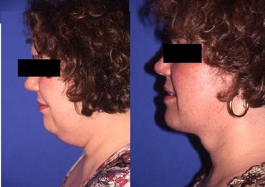 Liposuccion, cas 37, photographie avant et après