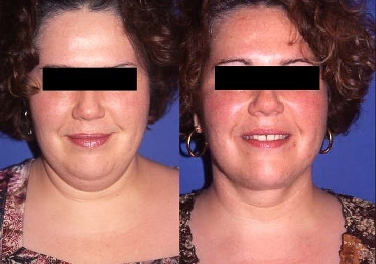Liposuccion, cas 38, photographie avant et après