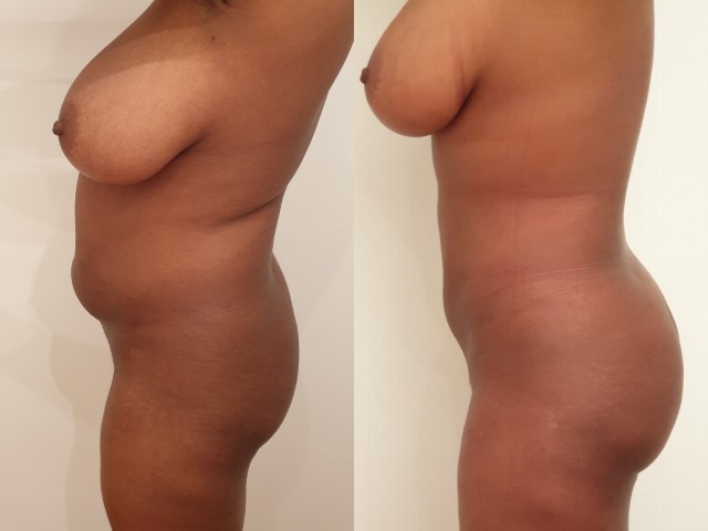 Liposuccion, cas 39, photographie avant et après