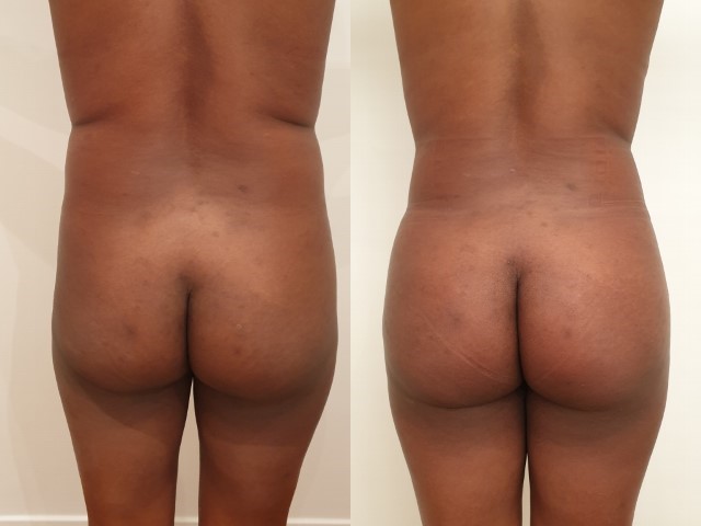 Liposuccion, cas 40, photographie avant et après