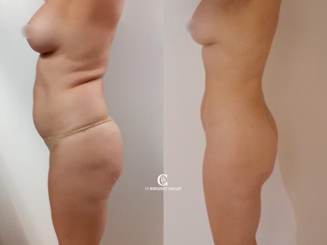 Liposuccion, cas 42, photographie avant et après
