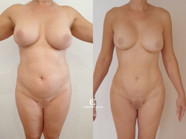 Liposuccion, cas 43, photographie avant et après