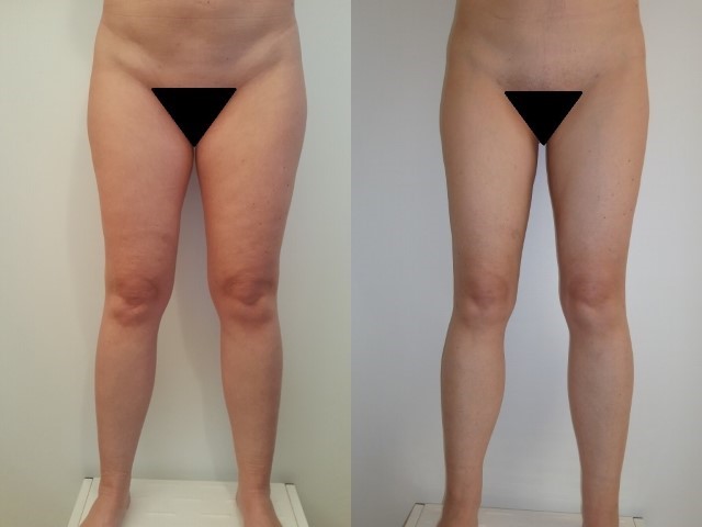 Remodelage jambes et mollets, cas 1, photographie avant et après