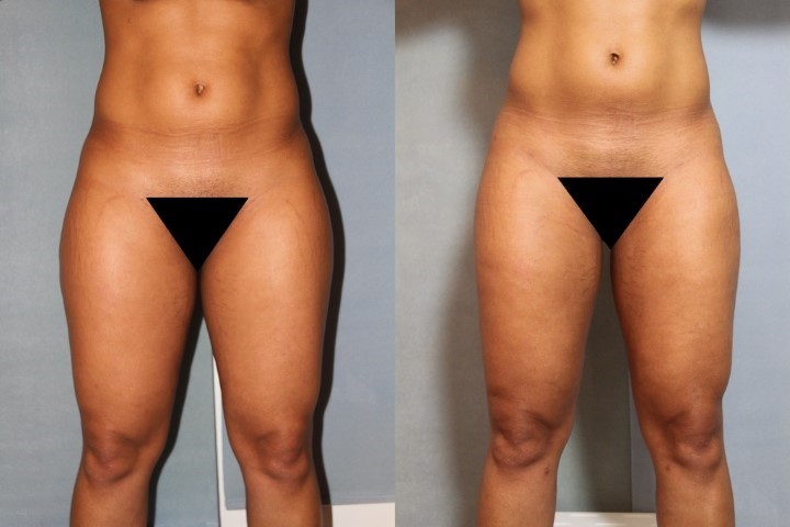 Remodelage jambes et mollets, cas 2, photographie avant et après