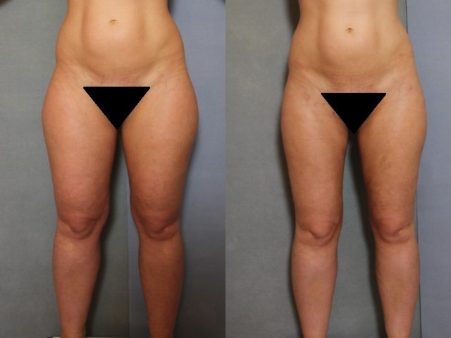 Remodelage jambes et mollets, cas 3, photographie avant et après