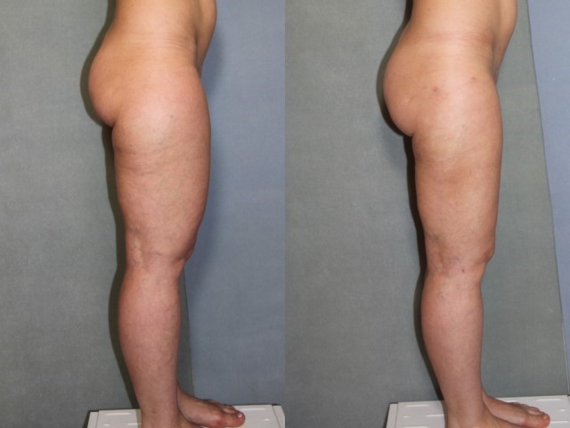 Remodelage jambes et mollets, cas 4, photographie avant et après