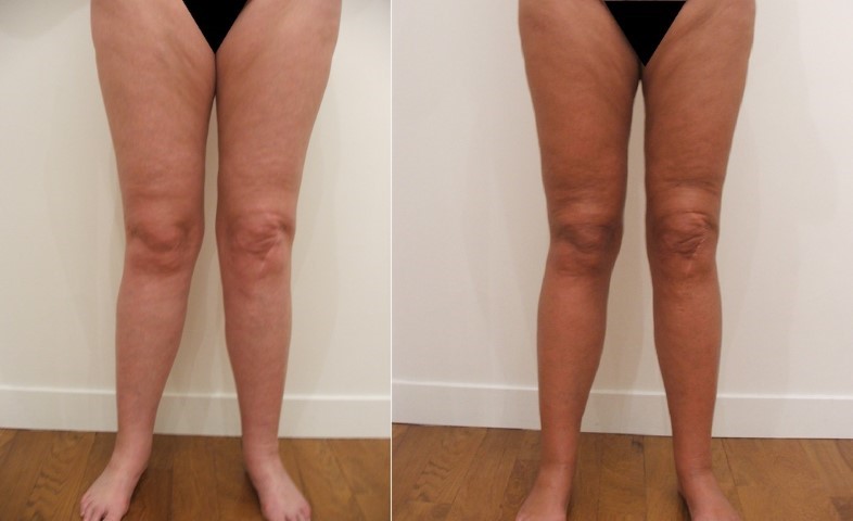 Remodelage jambes et mollets, cas 5, photographie avant et après