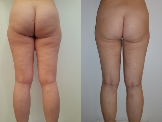 Remodelage jambes et mollets, cas 6, photographie avant et après