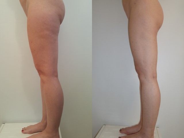 Remodelage jambes et mollets, cas 7, photographie avant et après