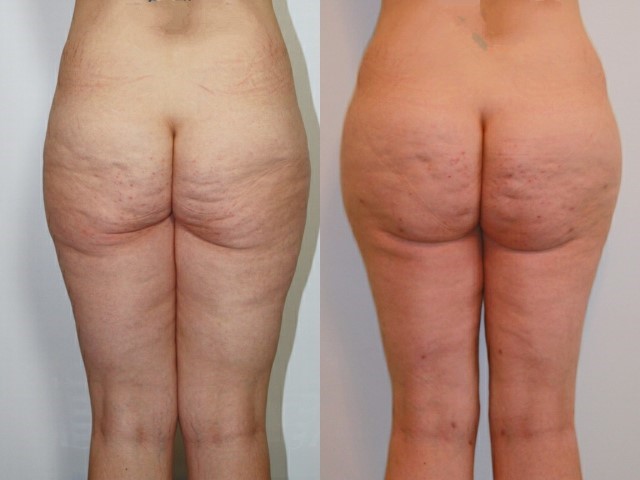Remodelage jambes et mollets, cas 8, photographie avant et après