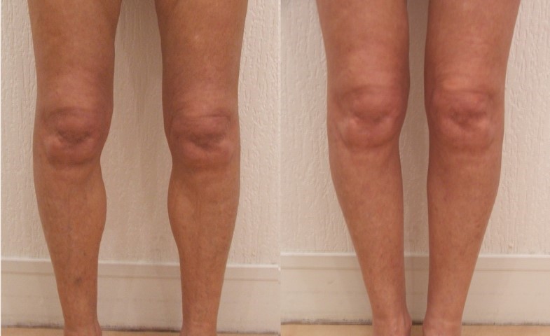 Remodelage jambes et mollets, cas 9, photographie avant et après