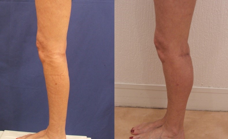 Remodelage jambes et mollets, cas 10, photographie avant et après