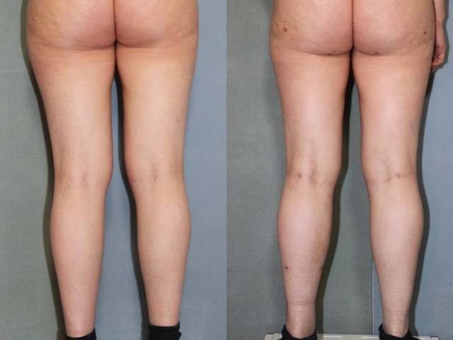 Remodelage jambes et mollets, cas 11, photographie avant et après