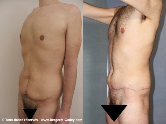 Bodylift, cas 2, photographie avant et après