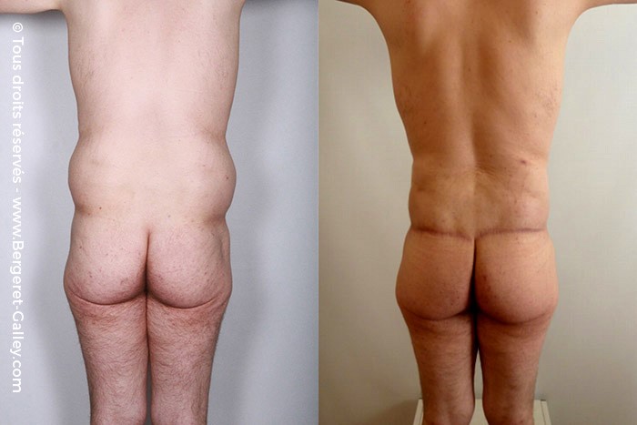 Bodylift, cas 4, photographie avant et après