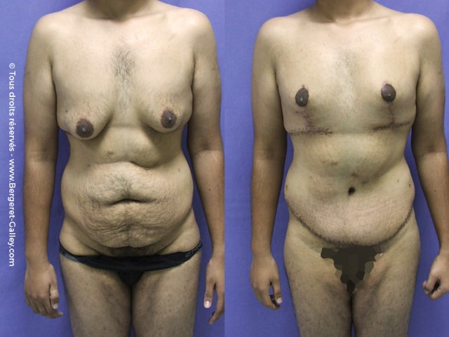 Bodylift, cas 6, photographie avant et après